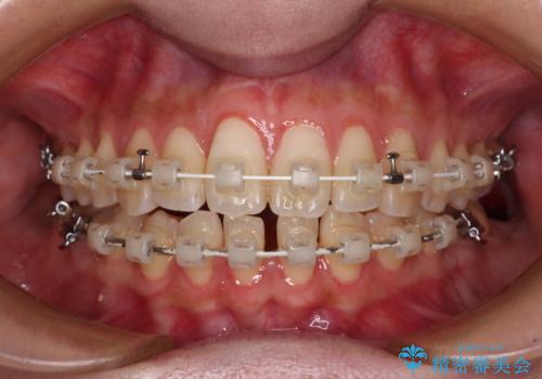 下顎前歯の欠損歯列 ワイヤー装置での矯正治療の治療中