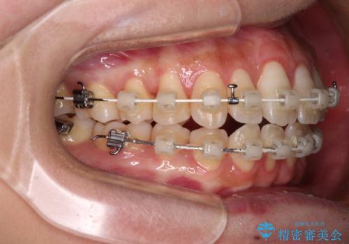 下顎前歯の欠損歯列　ワイヤー装置での矯正治療の治療中