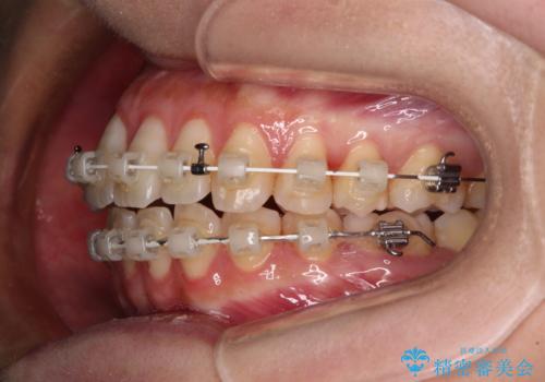 下顎前歯の欠損歯列 ワイヤー装置での矯正治療の治療中