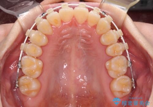 下顎前歯の欠損歯列　ワイヤー装置での矯正治療の治療中