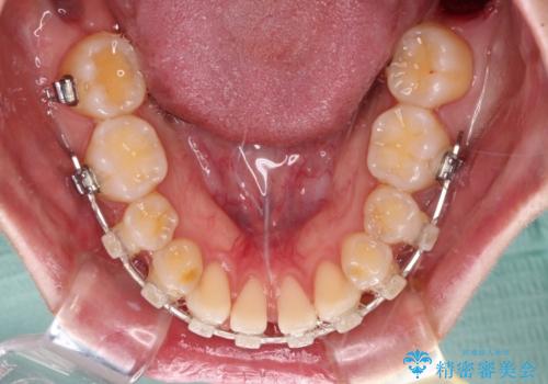 下顎前歯の欠損歯列 ワイヤー装置での矯正治療の治療中