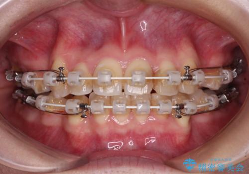 八重歯と正中のズレ　ワイヤー装置での抜歯矯正の治療中
