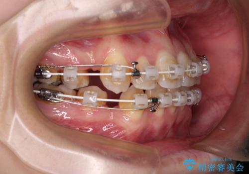 八重歯と正中のズレ ワイヤー装置での抜歯矯正の治療中