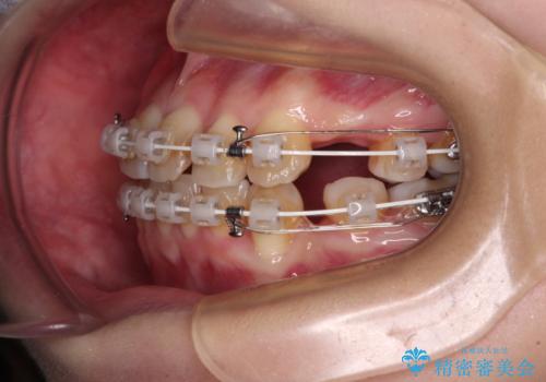 八重歯と正中のズレ ワイヤー装置での抜歯矯正の治療中