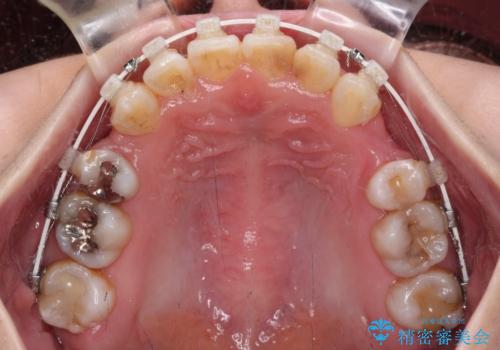 八重歯と正中のズレ ワイヤー装置での抜歯矯正の治療中