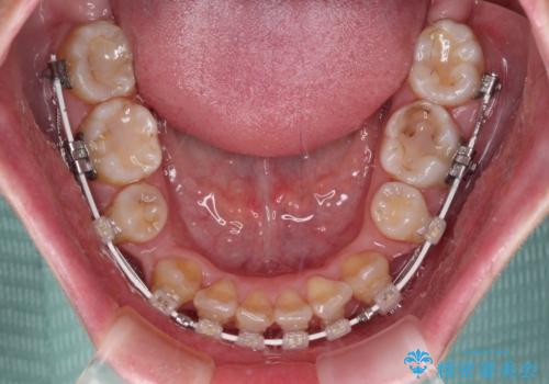 八重歯と正中のズレ ワイヤー装置での抜歯矯正の治療中