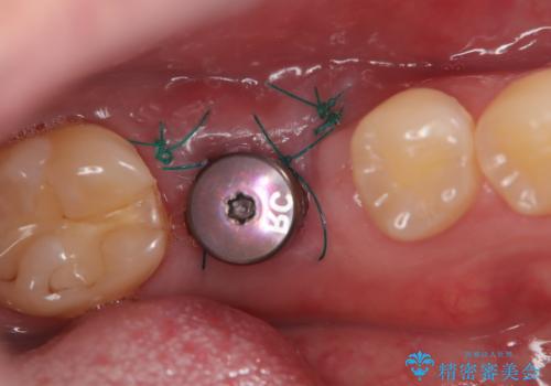 失ったままの臼歯 インプラントによる治療の治療中