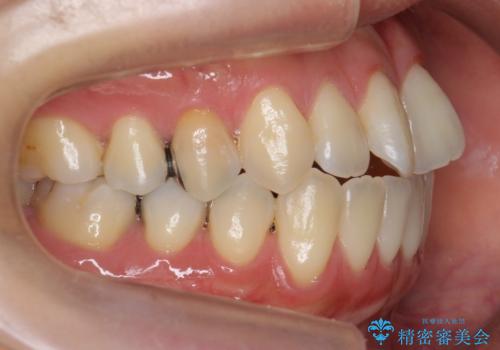 前歯のがたつき 若干受け口 インビザラインでの治療前