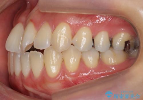 前歯のがたつき 若干受け口 インビザラインでの治療前