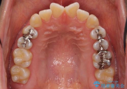 前歯のがたつき 若干受け口 インビザラインでの治療前