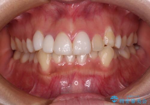 前歯のデコボコが気になる　インビザラインによる矯正治療の症例 治療前