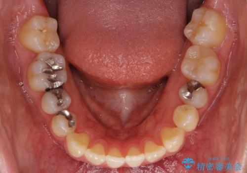 前歯のがたつき 若干受け口 インビザラインでの治療前