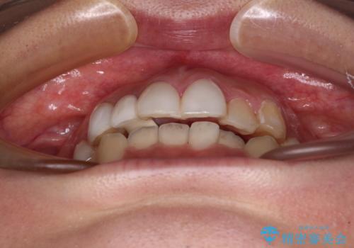 前歯のデコボコが気になる　インビザラインによる矯正治療の治療前