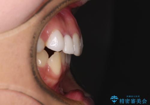 前歯のデコボコが気になる　インビザラインによる矯正治療の治療前