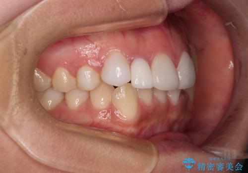 前歯のデコボコが気になる インビザラインによる矯正治療の治療前