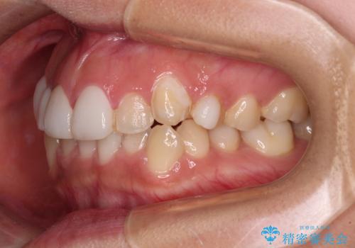 前歯のデコボコが気になる インビザラインによる矯正治療の治療前