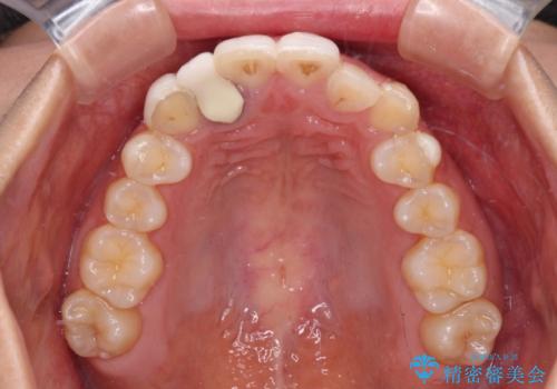 前歯のデコボコが気になる インビザラインによる矯正治療の治療前