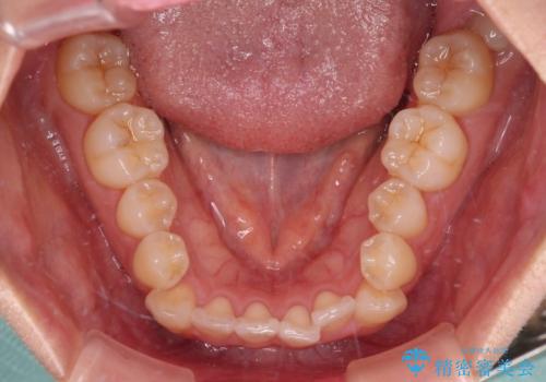 前歯のデコボコが気になる インビザラインによる矯正治療の治療前