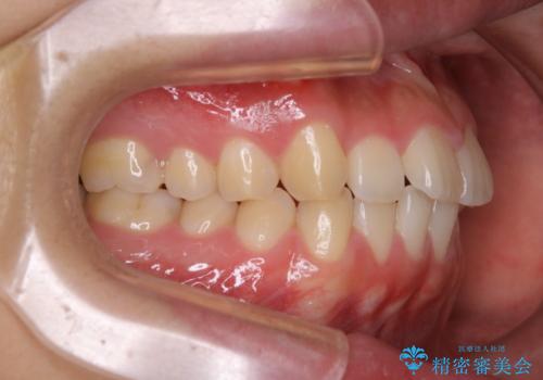 インビザライン矯正 過去に矯正治療したが、また前歯にがたつきがでてきて治したいの治療前