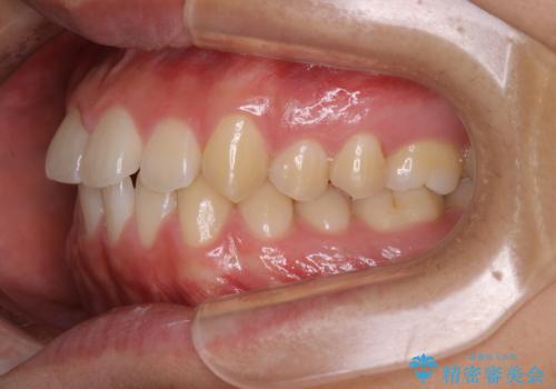 インビザライン矯正 過去に矯正治療したが、また前歯にがたつきがでてきて治したいの治療前