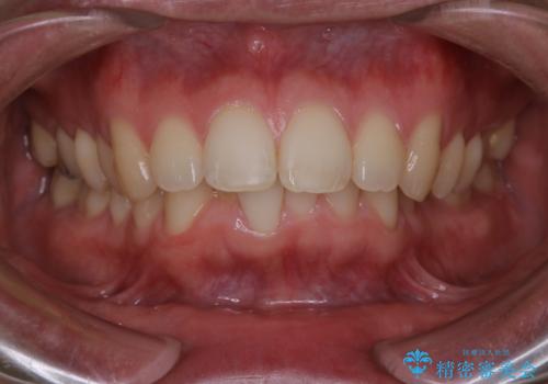 がたつき、口ゴボ(出っ歯)、真ん中のずれを抜歯矯正治療で治す。ワイヤー矯正治療