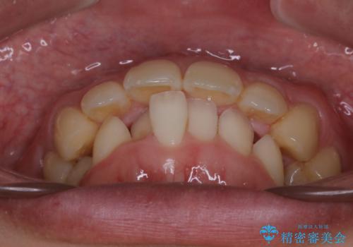 がたつき、口ゴボ(出っ歯)、真ん中のずれを抜歯矯正治療で治す。ワイヤー矯正治療の治療前