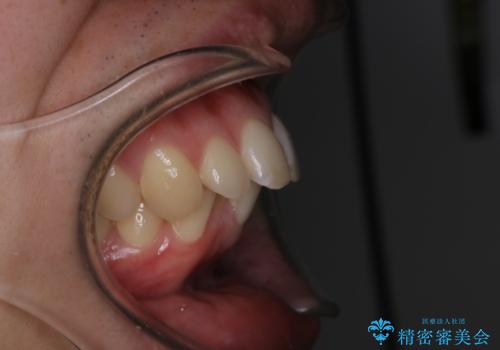 がたつき、口ゴボ(出っ歯)、真ん中のずれを抜歯矯正治療で治す。ワイヤー矯正治療の治療前