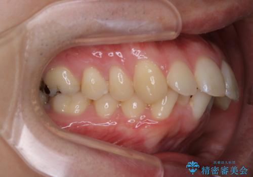 がたつき、口ゴボ(出っ歯)、真ん中のずれを抜歯矯正治療で治す。ワイヤー矯正治療の治療前