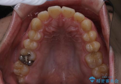 がたつき、口ゴボ(出っ歯)、真ん中のずれを抜歯矯正治療で治す。ワイヤー矯正治療の治療前