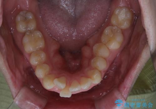 がたつき、口ゴボ(出っ歯)、真ん中のずれを抜歯矯正治療で治す。ワイヤー矯正治療の治療前