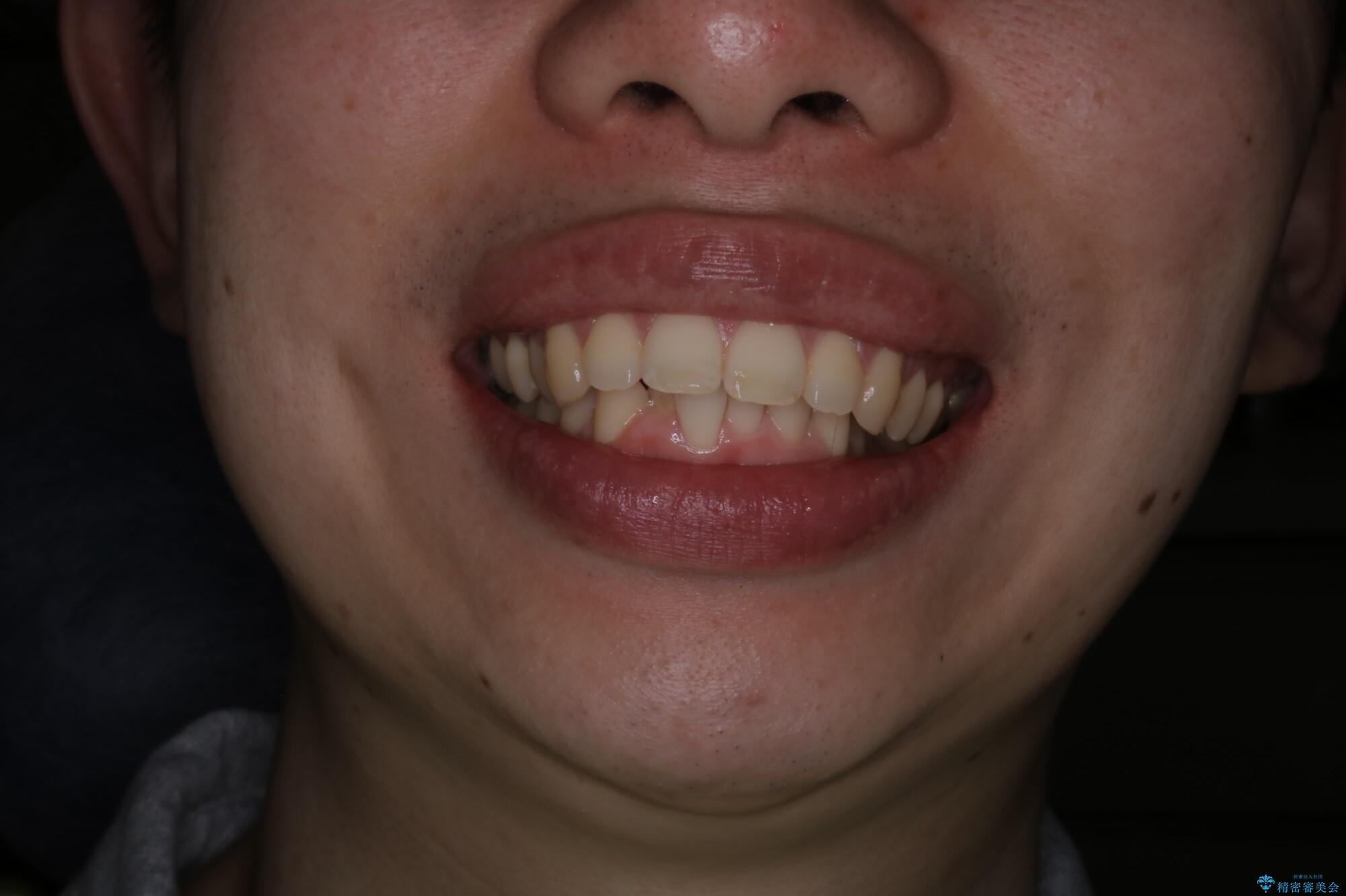 がたつき、口ゴボ(出っ歯)、真ん中のずれを抜歯矯正治療で治す。ワイヤー矯正治療の治療前(顔貌)