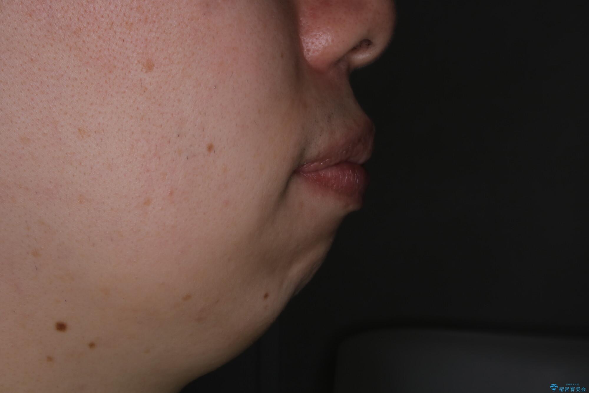 がたつき、口ゴボ(出っ歯)、真ん中のずれを抜歯矯正治療で治す。ワイヤー矯正治療の治療前(顔貌)