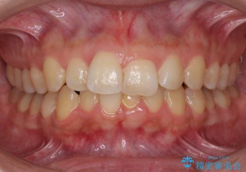 前歯のデコボコをインビザライン矯正で綺麗に改善の症例 治療前