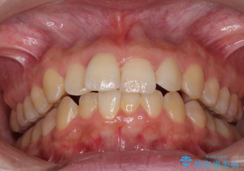 前歯のデコボコをインビザライン矯正で綺麗に改善の治療前