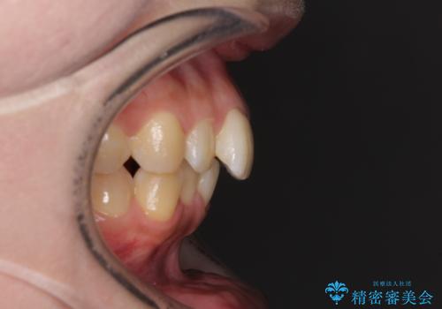 前歯のデコボコをインビザライン矯正で綺麗に改善の治療前