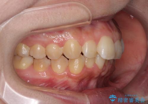 前歯のデコボコをインビザライン矯正で綺麗に改善の治療前