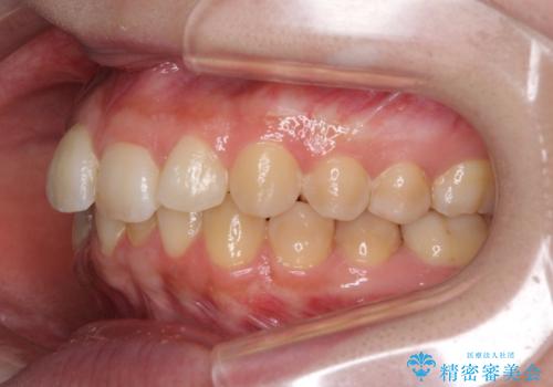 前歯のデコボコをインビザライン矯正で綺麗に改善の治療前