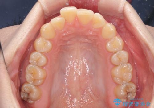 前歯のデコボコをインビザライン矯正で綺麗に改善の治療前