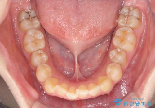 前歯のデコボコをインビザライン矯正で綺麗に改善の治療前