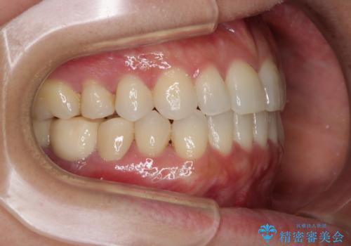 早い安いきれい!インビザラインライトで前歯のでこぼこ、反対咬合をなおすの治療後