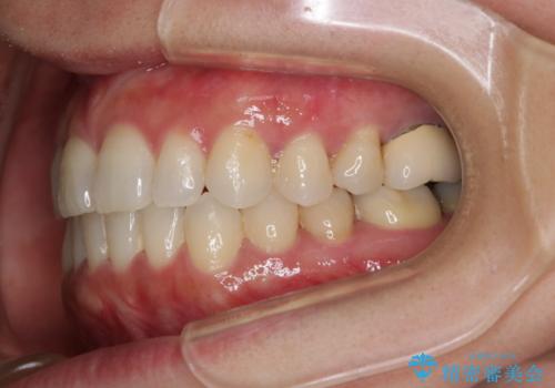 早い安いきれい!インビザラインライトで前歯のでこぼこ、反対咬合をなおすの治療後