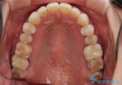 早い安いきれい!インビザラインライトで前歯のでこぼこ、反対咬合をなおすの治療後