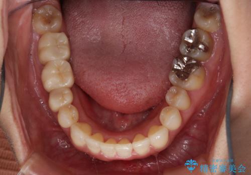 早い安いきれい!インビザラインライトで前歯のでこぼこ、反対咬合をなおすの治療後