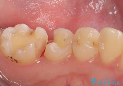 【セラミックインレー】詰め物が外れたので、ついでに白くしたいの治療中
