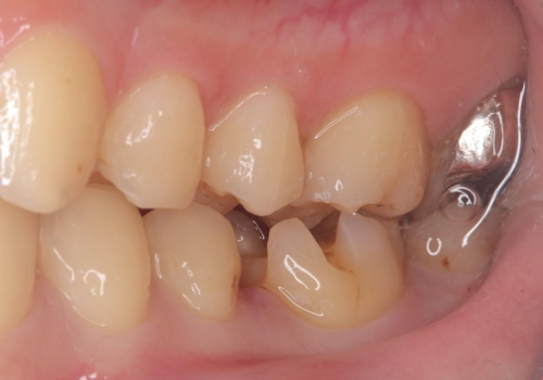 【セラミックインレー】詰め物が外れたので、ついでに白くしたいの治療中