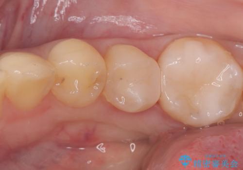 【セラミックインレー】詰め物が外れたので、ついでに白くしたいの症例 治療後
