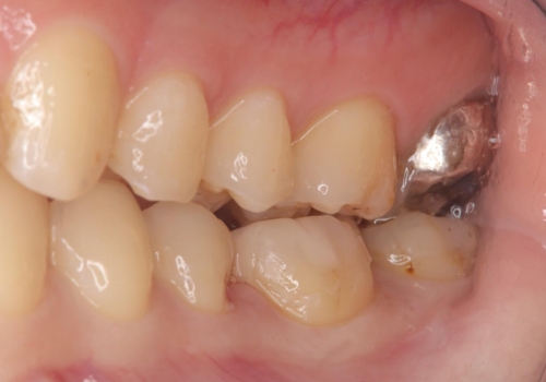【セラミックインレー】詰め物が外れたので、ついでに白くしたいの治療後