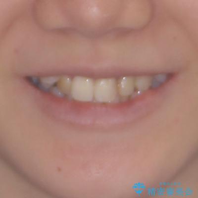 八重歯と正中のズレ ワイヤー装置での抜歯矯正の治療前(顔貌)