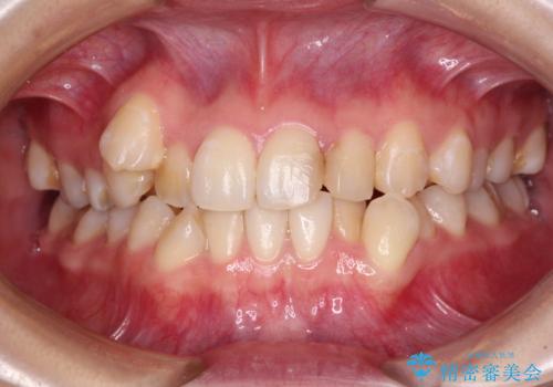 八重歯と正中のズレ　ワイヤー装置での抜歯矯正の症例 治療前