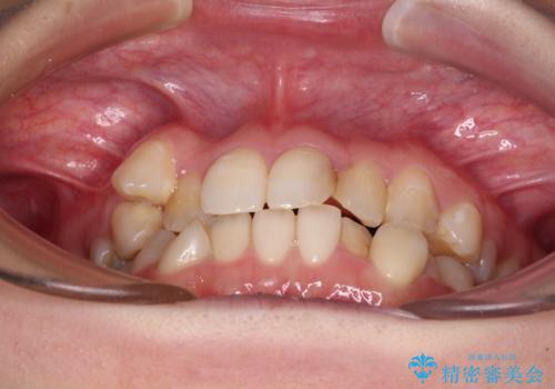 八重歯と正中のズレ　ワイヤー装置での抜歯矯正の治療前